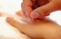 Overview of Chinese Acupuncture